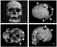 Photo credit: Alena Sefcakova, Slovak National Museum; Description: DIAGNOSIS Evidence of tumors in the skull of a male skeleton exhumed from an early medieval cemetery in Slovakia. Often thought of as a modern disease, cancer has always been with us.