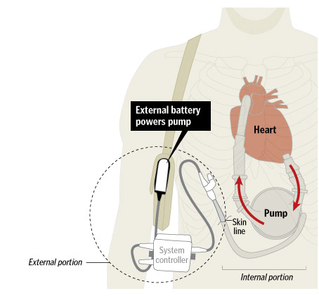 SOURCE: Thoratec | GRAPHIC: The Washington Post - April 23, 2008 